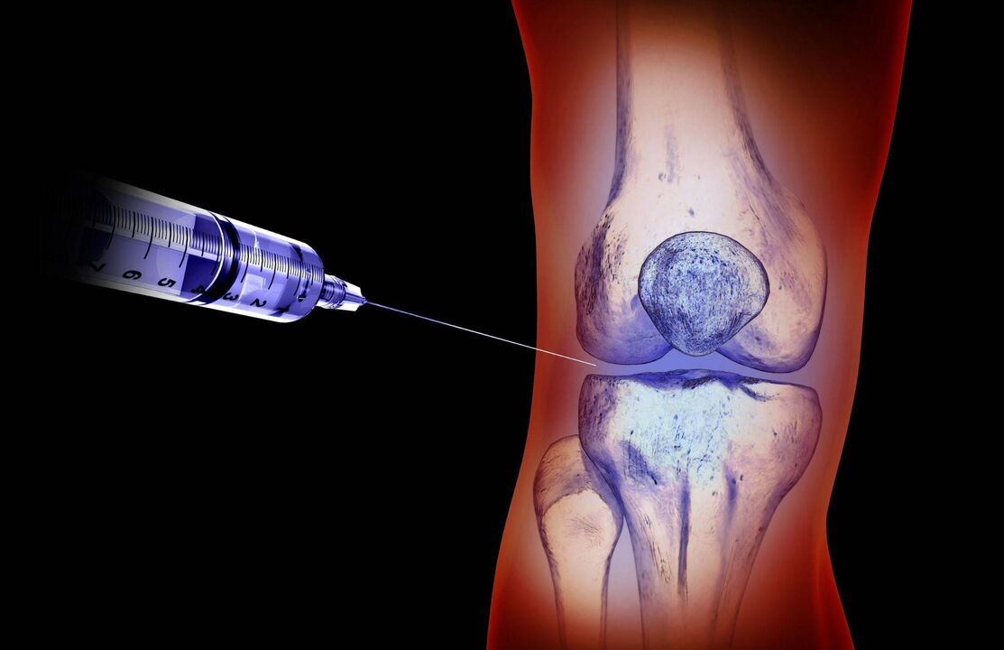 inyecciones intraarticulares para la osteoartritis