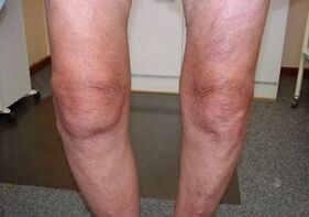 Cómo tratar la osteoartritis en la articulación de la rodilla