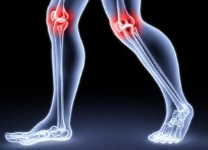 Las razones para el desarrollo de la osteoartritis de rodilla