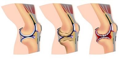 Etapas de desarrollo de la osteoartritis de la articulación de la rodilla