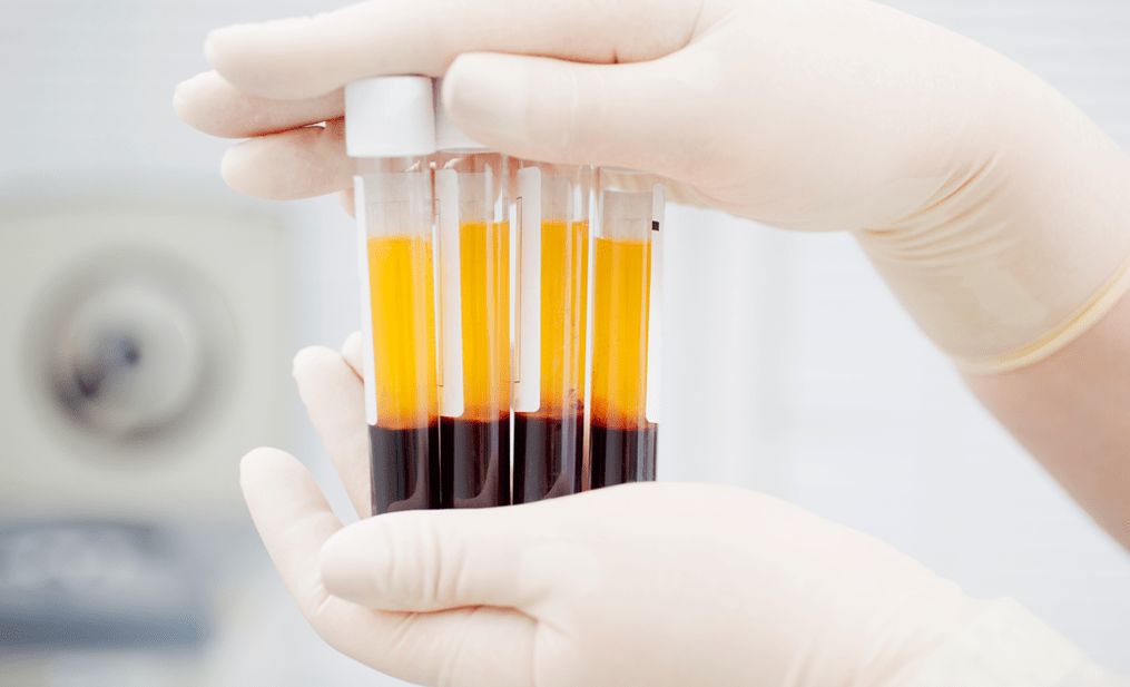 Plasma rico en plaquetas para el tratamiento con PRP de la osteoartritis