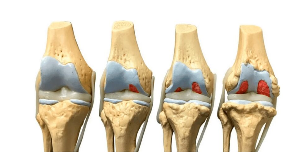 grado de osteoartritis de las articulaciones